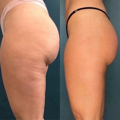 Body Sculpting Device