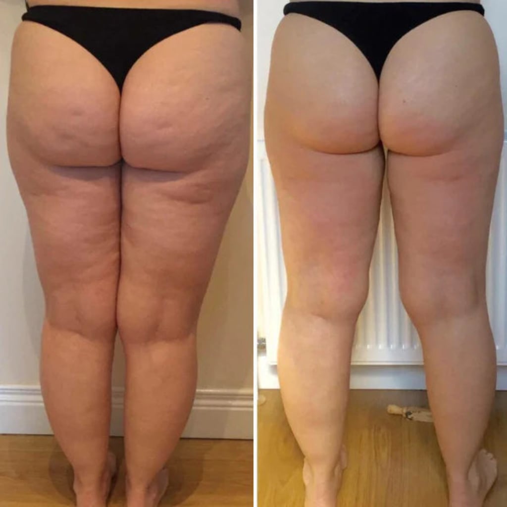 Body Sculpting Device