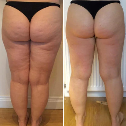 Body Sculpting Device