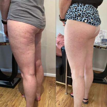 Body Sculpting Device
